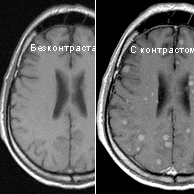 Метастазы на МРТ головного мозга